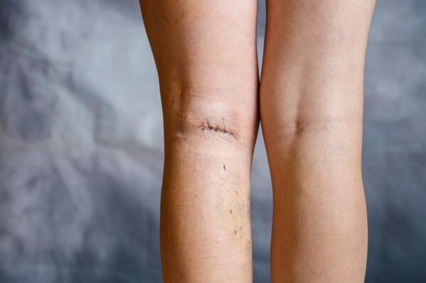costura en la pierna después de la cirugía para las venas varicosas