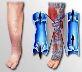 flujo sanguíneo en la pierna con venas varicosas