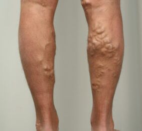 ganglios en las piernas con venas varicosas