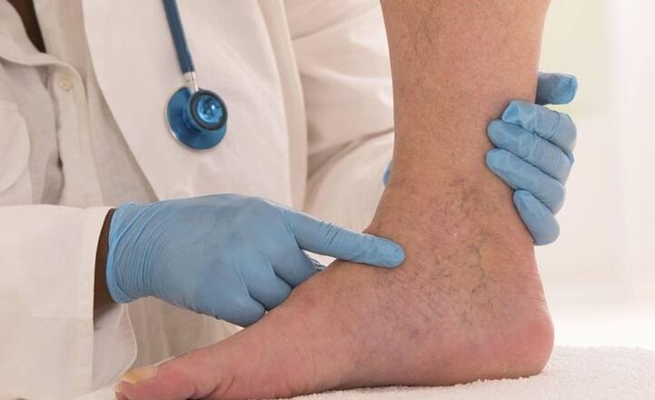 el médico examina la pierna con venas varicosas