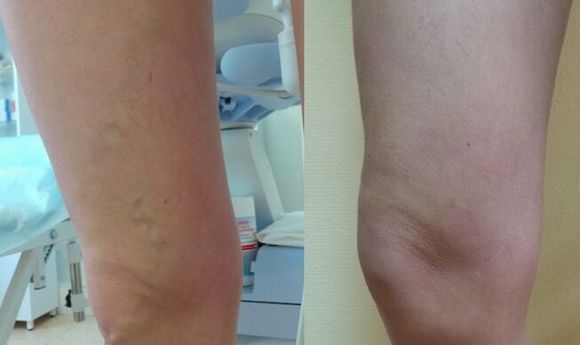 pierna antes y después del tratamiento de las varices reticulares