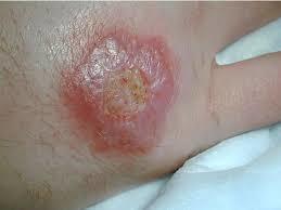 úlceras en la piel,