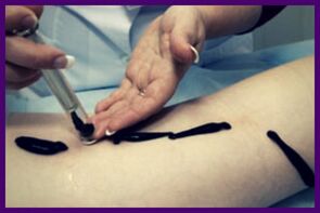 El procedimiento para tratar las varices con sanguijuelas (hirudoterapia)