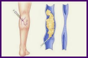 La escleroterapia es un método popular para deshacerse de las varices en las piernas. 