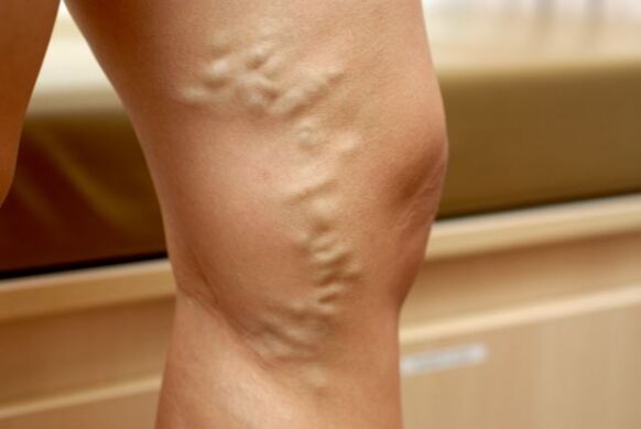 venas varicosas en la pierna con venas varicosas de la pelvis pequeña