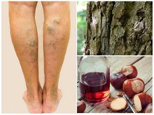 el tratamiento de varices de las venas en las piernas remedios