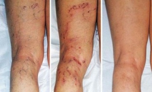 síntomas de varices en las piernas
