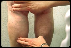 El médico examina las piernas con varices