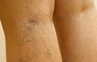 tratamiento de varices en las piernas