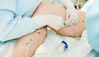 métodos para tratar las varices en las piernas en mujeres