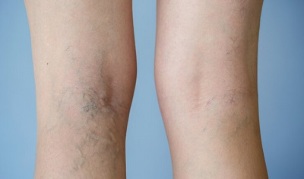 signos de varices en las piernas en mujeres